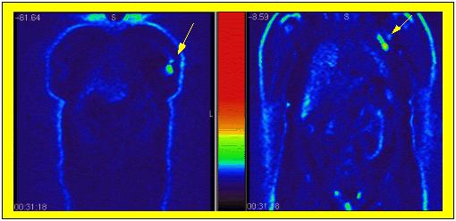 Application to tumors PET imaging is very accurate in differentiating malignant from benign growths, as well as showing the spread of malignant tumors.