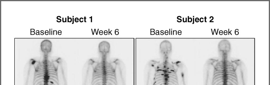 Cabozantinib& turn-over osseo(i) mcrpc FaseII: PFS, riduzionedel dolore