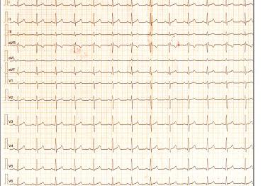 Analisi Vettor-cardiogramma Il modulo di analisi VCG fornisce ulteriori vantaggi nella diagnosi dell ipertrofia ventricolare e atriale destra, del blocco di conduzione, dell