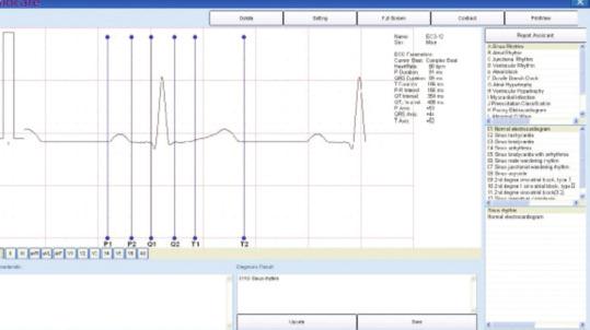 Analisi Vettor-cardiogramma Il modulo di analisi VCG fornisce ulteriori vantaggi nella diagnosi dell ipertrofia ventricolare e atriale destra, del blocco di