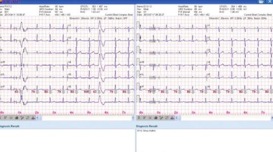 Analisi Pacemaker Una speciale funzione consente l analisi dei battiti stimolati da Pacemaker durante la registrazione in modalità automatica.
