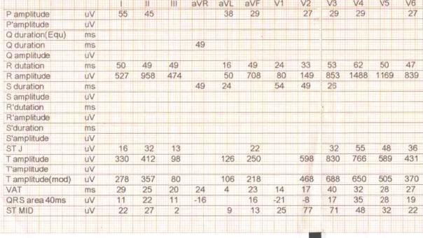 Il software di analisi degli eventi aritmici consente di visualizzare la traccia ECG e