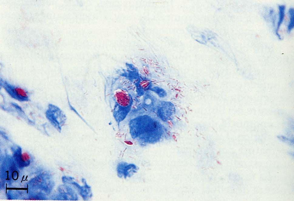 La colorazione di Ziehl-Neelsen - per batteri acido-resistenti (Micobatteri).