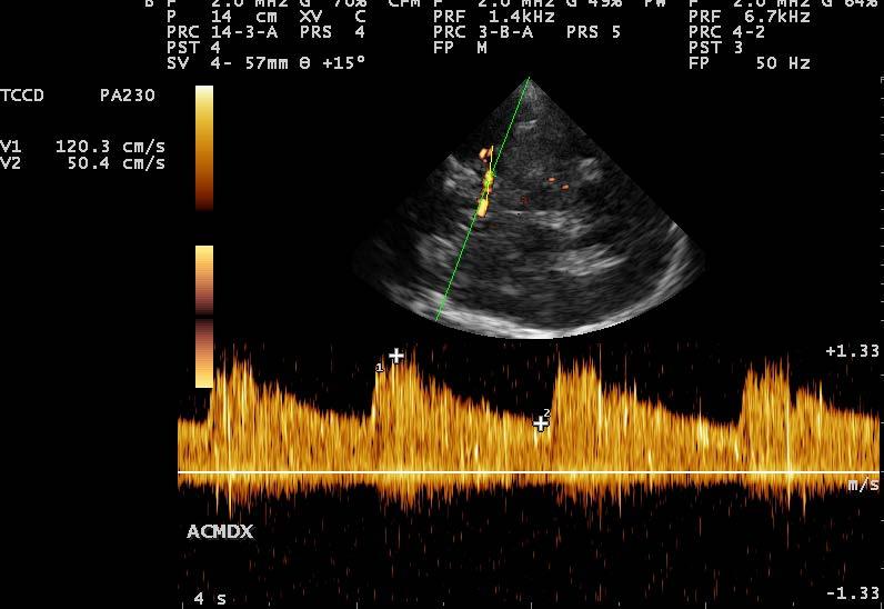 acuto CIS ECD TSA CIS