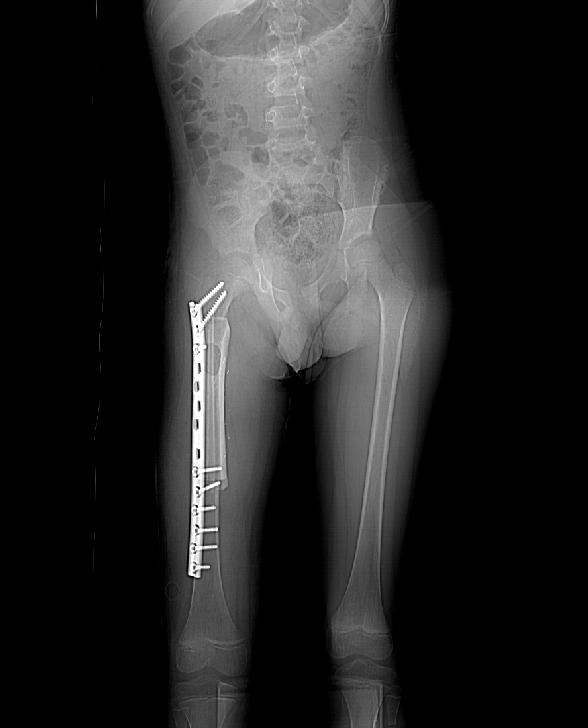 valutazione clinica dello stato/trattamento/evoluzione dell'osteoporosi, ) Il comportamento meccanico di un