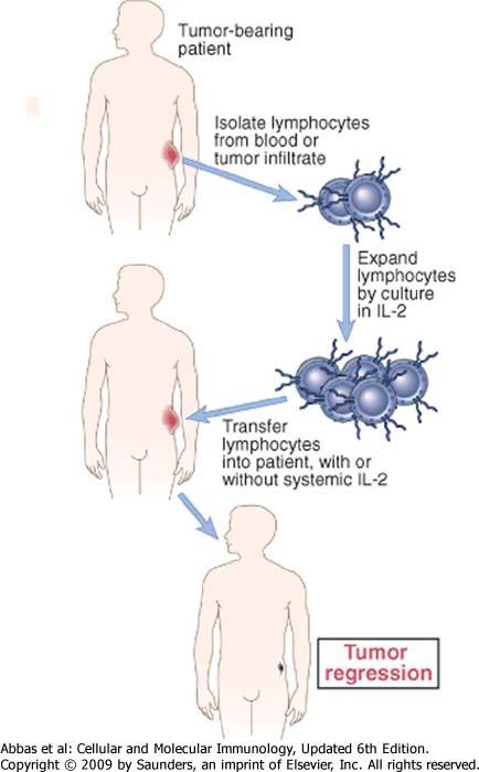 Immunoterapia passiva terapia cellulare adottiva Cellule LAK (NK 90% e L) leucociti da sangue periferico attivati in vitro Cellule TIL (linfociti infiltranti