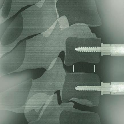 di brillanza. La marcatura distale della gabbia deve trovarsi 1 mm prima del muro posteriore della vertebra.