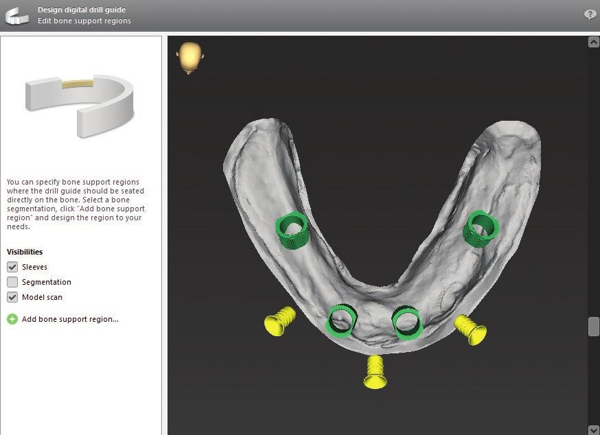 KEY FEATURES Comprehensive library with implant systems from all major manufacturers and many sleeve and guided systems. Own elements/systems can be added.