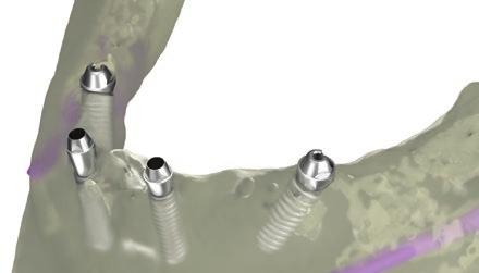 of correctly angulated screwretained abutments based