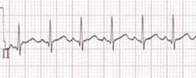 P-QRST RR ciclo completo ventricolare PP ciclo