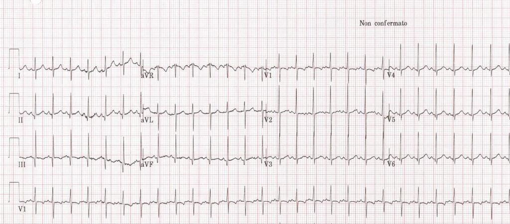 ECG