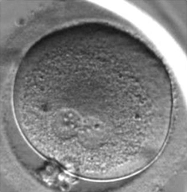 Questa differenza nei tempi può essere spiegata con il fatto che durante la ICSI lo spermatozoo entra direttamente nell ovocita, saltando la penetrazione delle cellule del cumulo, l interazione con