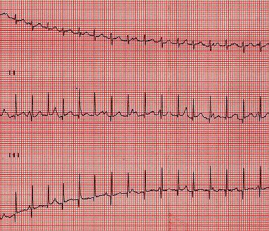 it 56 SATE/SEE Non permette innesco TAE Non interrompe TAE SEE per mappa attivazione endocardica SEE pre ablazione Manovre vagali e test farmacologici acuti Manovre vagali: variazione conduzione AV