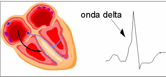 Flutter atriale Terapia Sindrome di WPW e TRAV Riduzione della frequenza cardiaca (Azione di di blocco sul nodo atrio-ventricolare) Conversione Farmacologica (Farmaci anti-aritmici classe Ic; classe