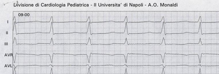 TPSV da Rientro Nodale AV Circuito della tachicardia interno al Nodo Atrio-Ventricolare ECG normale al di fuori della crisi Regolarità del QRS Non evidenza