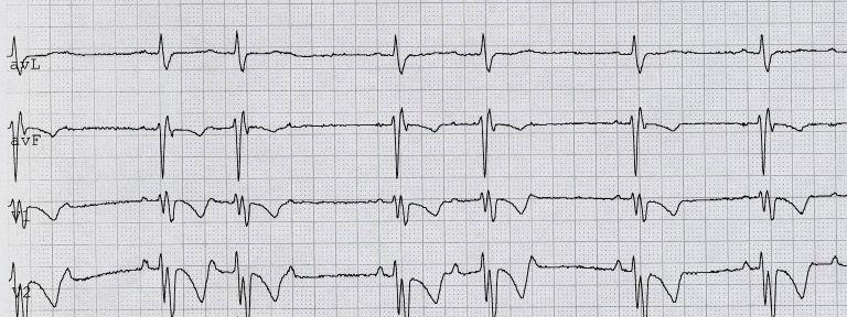 reumatica acuta Cardiopatie Congenite Iatrogeno(Digitale; β-bloc.