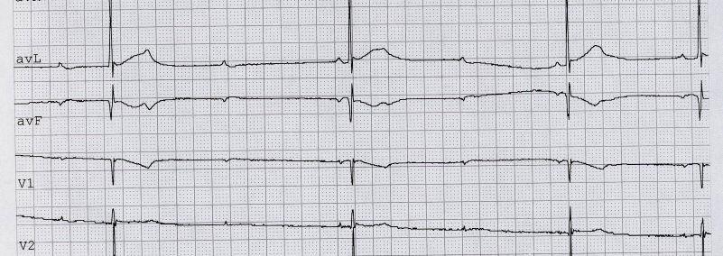 it 32 Blocco AV Indicazioni per l Impianto del PMK Classe I: BAV III associato a: Sintomi Periodi documentati di asistolia > 3 seconds Ritmo di scappamento < 40 bpm in paziente sveglio Blocco AV III