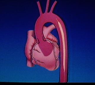 Il palloncino viene posizionato in aorta discendente si