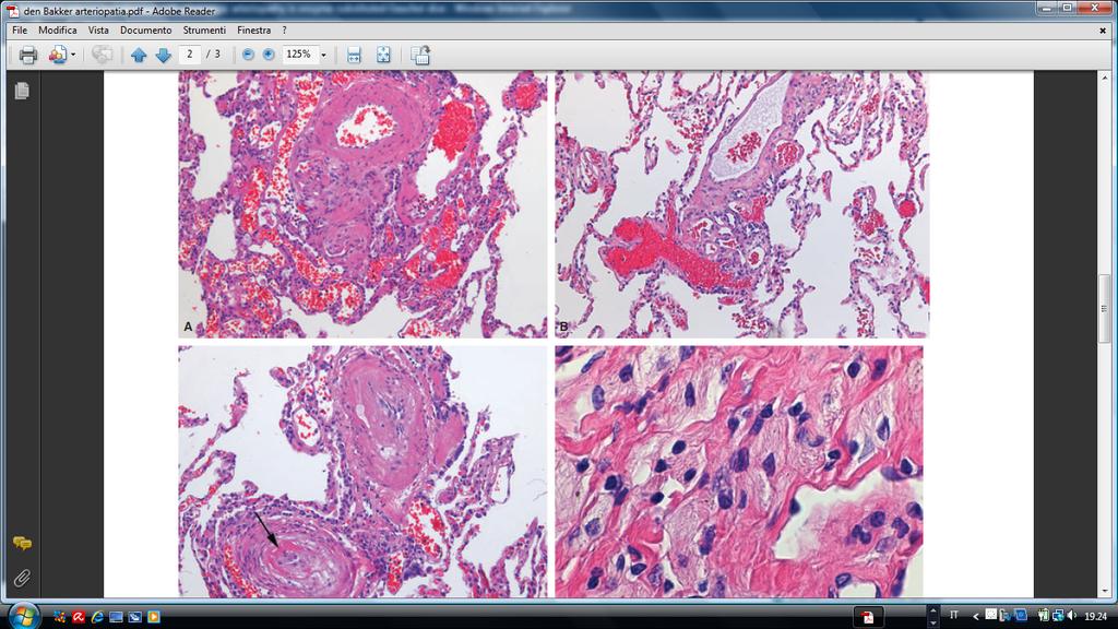 settali e conseguente fibrosi Invasione degli alveoli con