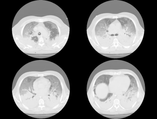 Caso Clinico EGA ph 7,25 PaCO 2 62,5 mmhg PaO 2 /FiO 2 47 VCM ECMO SpO 2 <85% per almeno 1h OI>25 per 6 h PaO 2 /FiO 2 <100 ph <7.