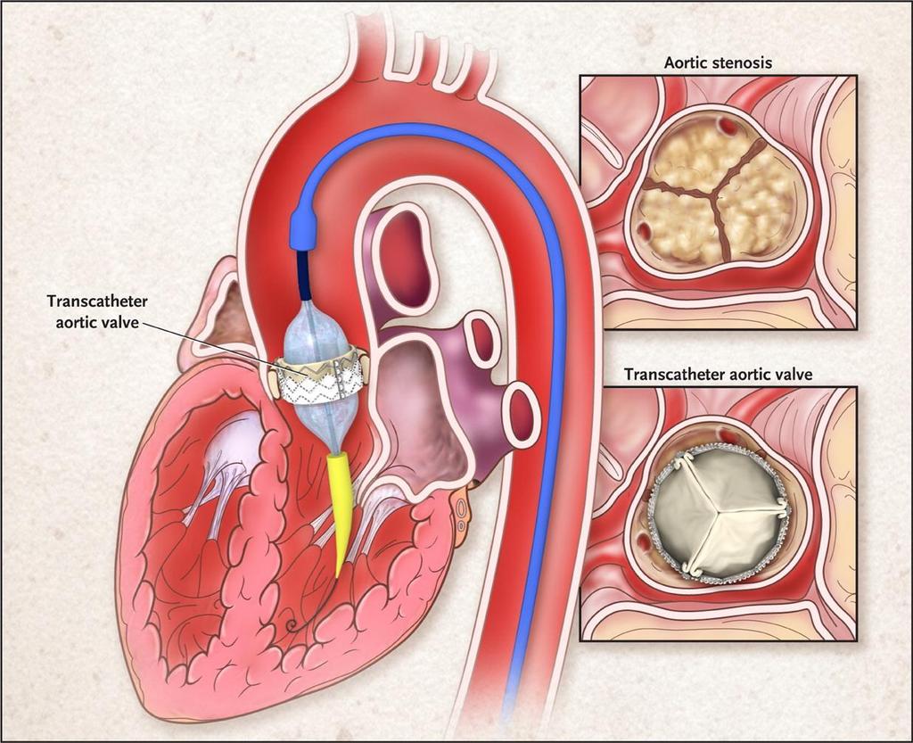 Transcatheter Aortic-Valve Replacement.