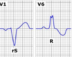 Bradicardie Blocco di branca sinistro Il setto interventricolare si depolarizza da destra verso sinistra e vi è un ritardo nell attivazione della parete libera del ventricolo sinistro QRS > 0.