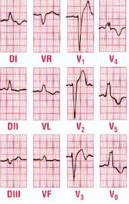 Blocco di branca sinistro Ritmo sinusale Intervallo PR normale Allargamento QRS Aspetto ad M del QRS, osservato più spesso in V4-V6 NB: il BBS