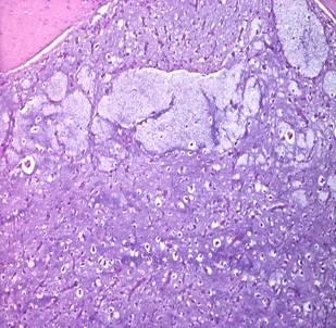 LIPOSARCOMA MIXOIDE