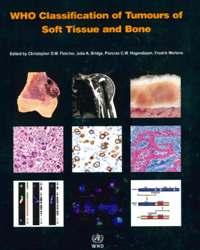 CLASSIFICAZIONE WHO DDLPS, despite itshigh grade morphology, exhibits a less aggressive clinical coursethan other types of high grade