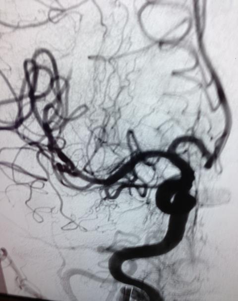 (injury) to mechanical