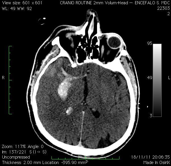 OCCLUSIONE