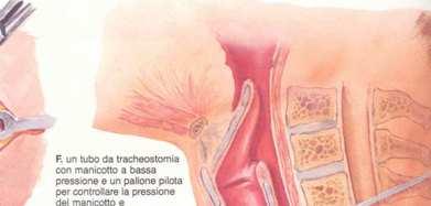 TRACHEOTOMIA INDICAZIONI VANTAGGI CARATTERISTICHE