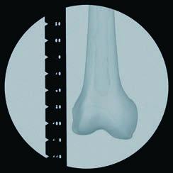 023 Regola radiografica per diametri dei chiodi per Expert Chiodi femorali, lunghezza 365 mm La lunghezza del chiodo necessaria si deve determinare dopo la riduzione della frattura del femore.