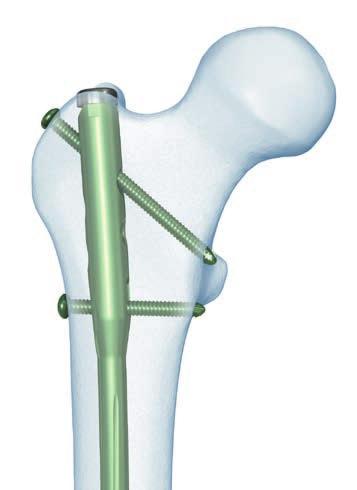 Facilità d'inserimento ed estrazione La superficie laterale appiattita riduce la compressione della corticale laterale e diminuisce la