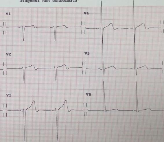 Rid. ST 50% a 60 min Si intende la riduzione del sopraslivellamento ST 50% rispetto al ECG diagnostico, misurato a 20 ms dalla fine del