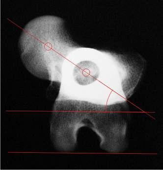 Capitolo 3 Studio delle deformità dell arto posteriore Figura 3.20: Angolo di versione calcolato su proiezione radiografica assiale (metodo diretto). misura la distanza geometrica fra tali punti.