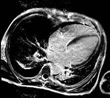 RISONANZA MAGNETICA CARDIACA Alle immagini post-contrasto tardive: Sfumato enhancement intramiocardico a Carico della