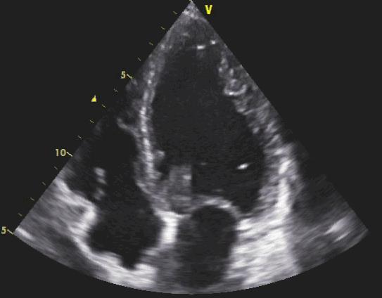 DIMISSIONE IL 12/01/2016 Discrete condizioni cliniche generali PA 105/70 mmhg, FC 85 bpm, SatO2 97 % in AA, Apiretico ECOCARDIO PRE DIMISSIONE: VS: Ipocinesi diffusa DTD 60 mm PROGRAMMA: