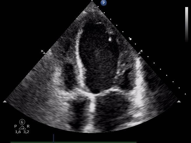 Splenomegalia di ndd aumentato rischio di malattia Linfoproliferativa 04/11/2015 SPLENECTOMIA DIAGNOSTICA ECOCARDIO (30/9/2015) VS: