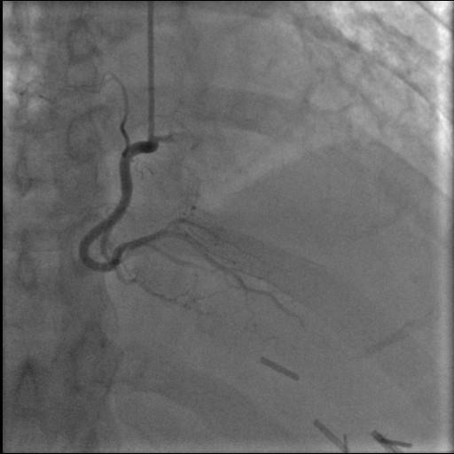 angiograficamente