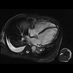 RISONANZA MAGNETICA CARDIACA VS di