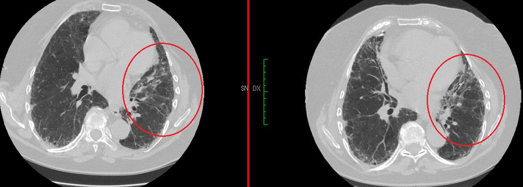 radiologico al tempo 0 e a distanza di 12