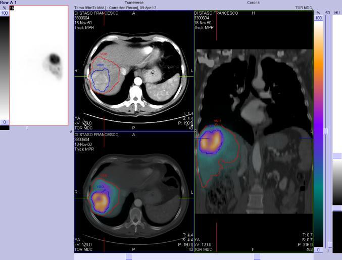 Trattamenti con dosimetria: situazione analoga ai fasci esterni D tumore: 334 Gy D irraggiato: 98 Gy D parenchima: 54 Gy Radioembolizzazione epatocarcinoma con 90Y microsfere in vetro: 3 GBq