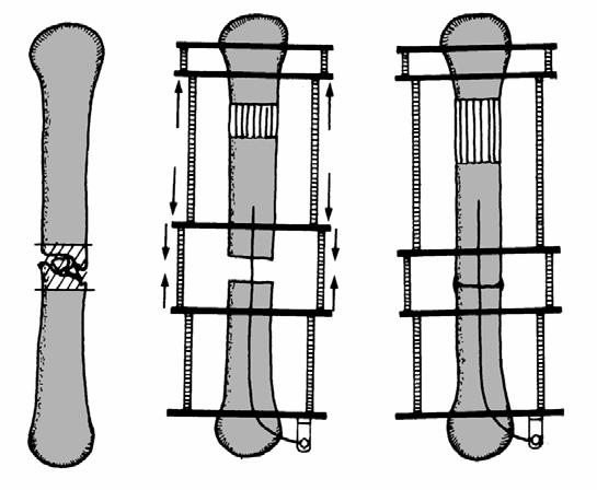 Pseudoartrosi Infette (M.A.