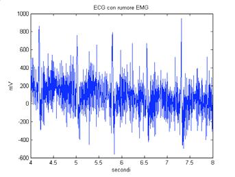 Eetto di un iltro passa basso ttenuazione dell EMG su di un tracciato ECG in LPF 35 Hz out lterazione dell ECG per inadeguatezza della