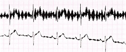 Disturbi su tracciati ECG Esempi: Disturbo a requenza di rete (50 Hz) mpiezza