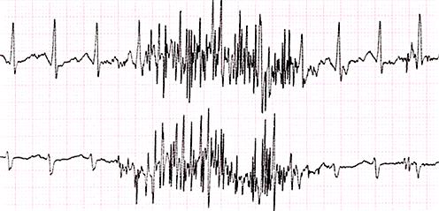 Disturbi su tracciati ECG Esempi: Disturbo a requenza di rete (60 Hz) Disturbo EMG