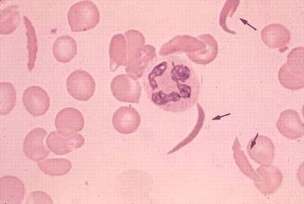 ETEROGENEITÀ CLINICA (FENOTIPICA): mutazioni a carico