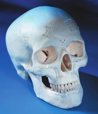 e nella zona infraorbitaria Fratture a livello della parete del seno frontale Trauma a livello della parte mediana del volto e ricostruzione dello scheletro craniofacciale Si consiglia di non