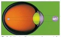 Fig. 3 - Occhio miope. l immagine va a fuoco avanti alla retina. Occorre una lente negativa per farla andare sulla retina oppure un intervento.
